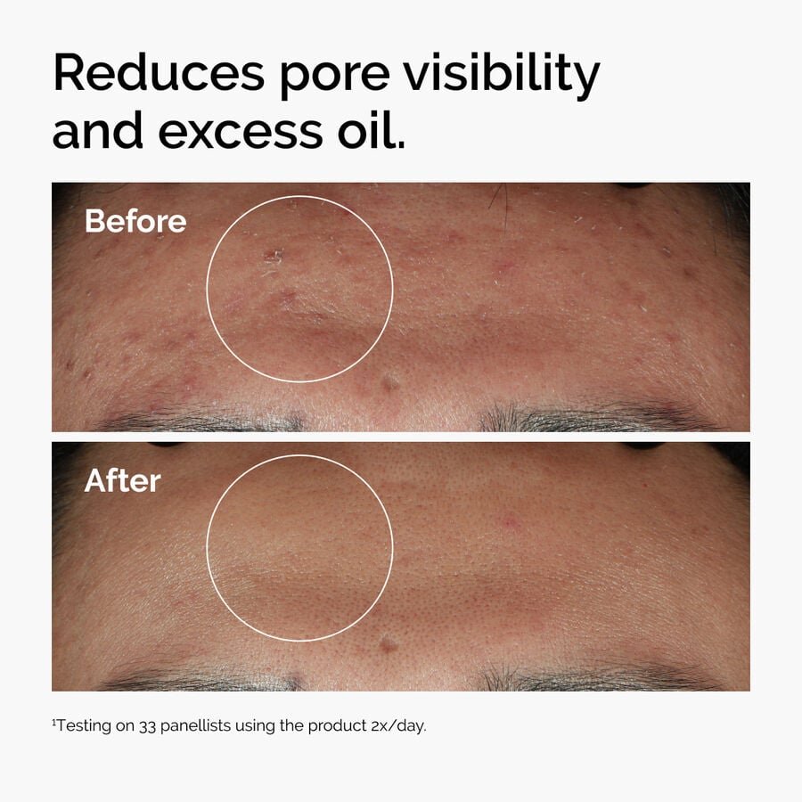 ord-niacinamide-zinc-blemish-serum-before-after-pores.jpg