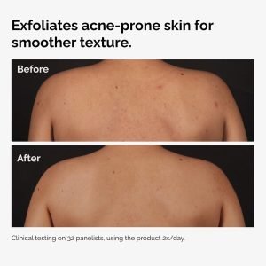 ord-salicylic-acid-body-serum-before-after-graphic-NA.jpg