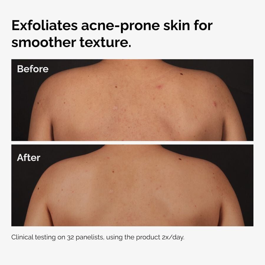 ord-salicylic-acid-body-serum-before-after-graphic-NA.jpg
