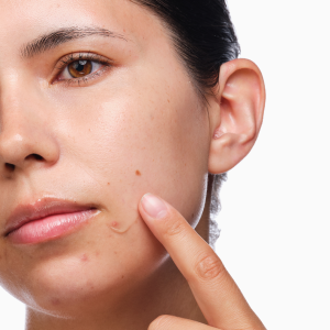 rdn-the-acne-set-application.png